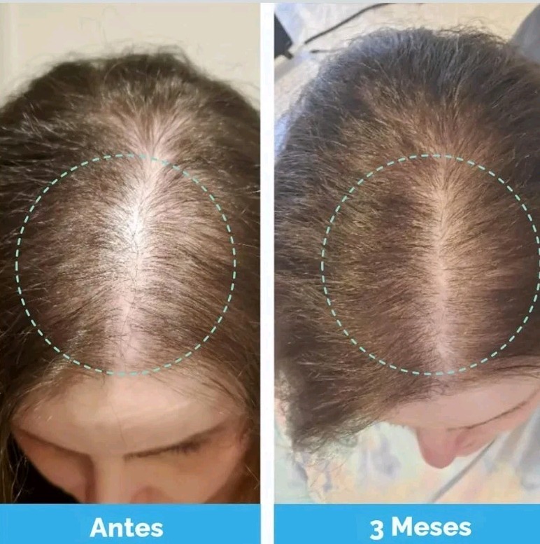 Baby Blues Postpartum Hair Loss Vitamins Passion Fruit Gummies Biotin Collagen
